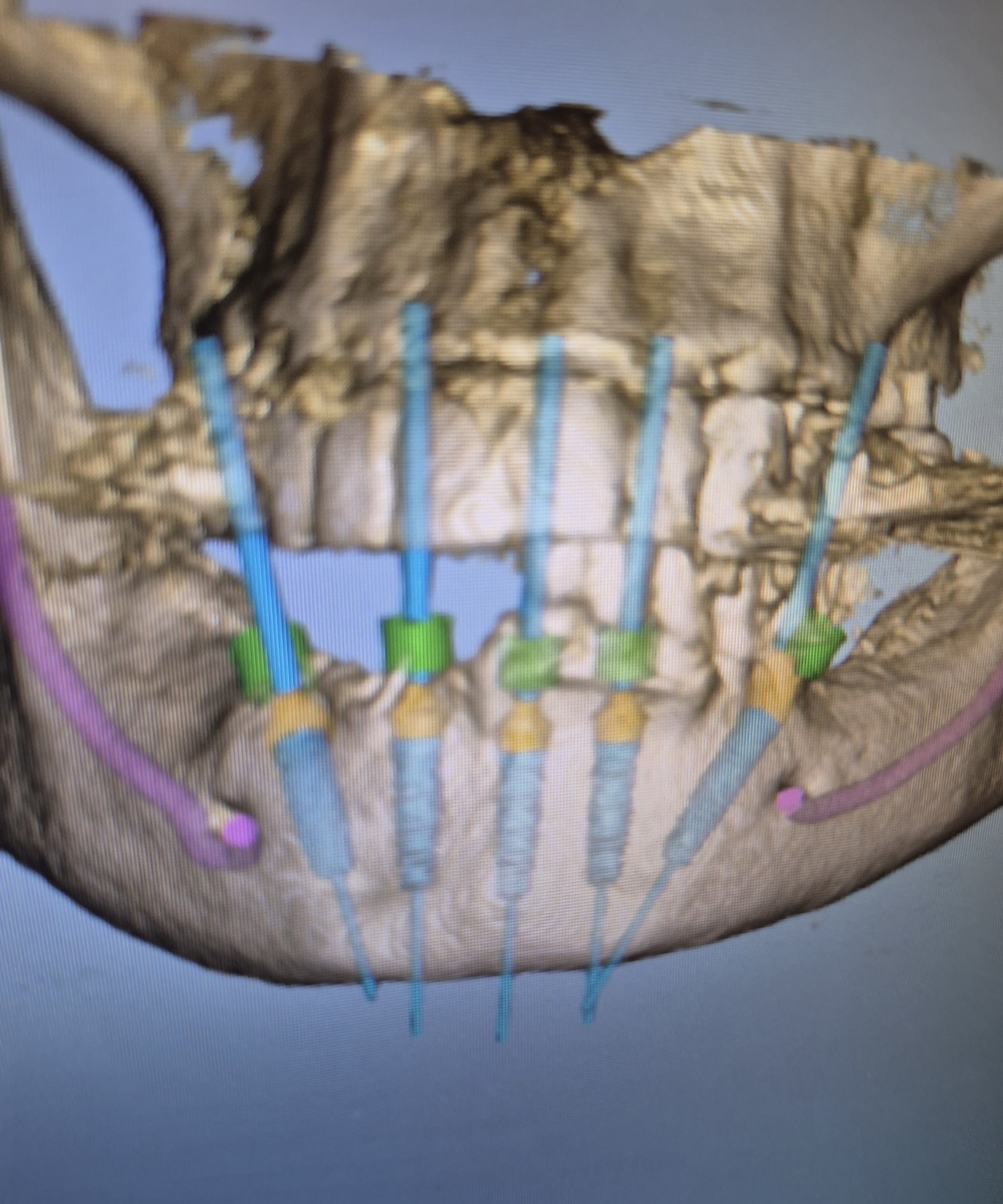 Digital dentistry workflow